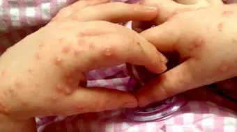 Brote de virus Coxsackie en Puebla: Suspenden clases en escuelas de Amalucan y la Mixteca