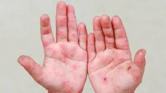 Detectan brote de virus Coxsackie en escuela de Ciudad Serdán