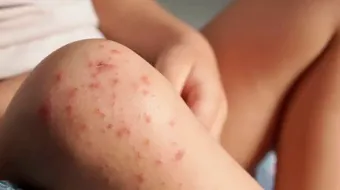 Brotes de virus Coxsackie aumentan en Puebla; suman 209 casos