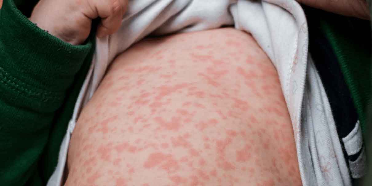 IMSS lanza cerco sanitario en San Jerónimo Coyula tras detectar casos de varicela y rubéola