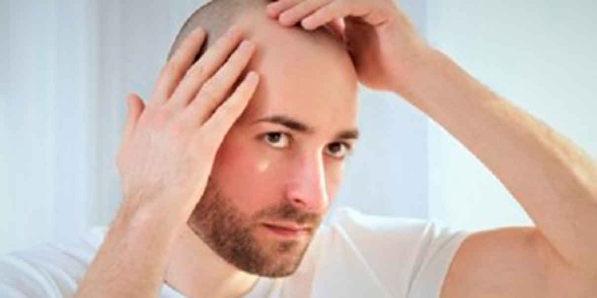 Alopecia en hombres