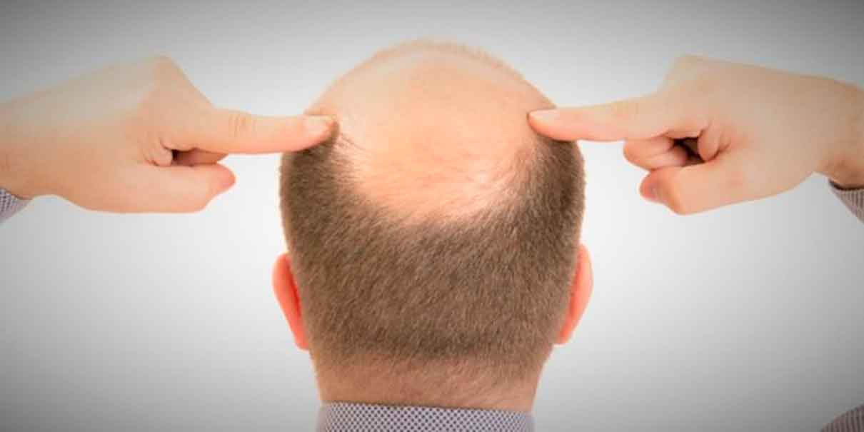 Alopecia en hombres