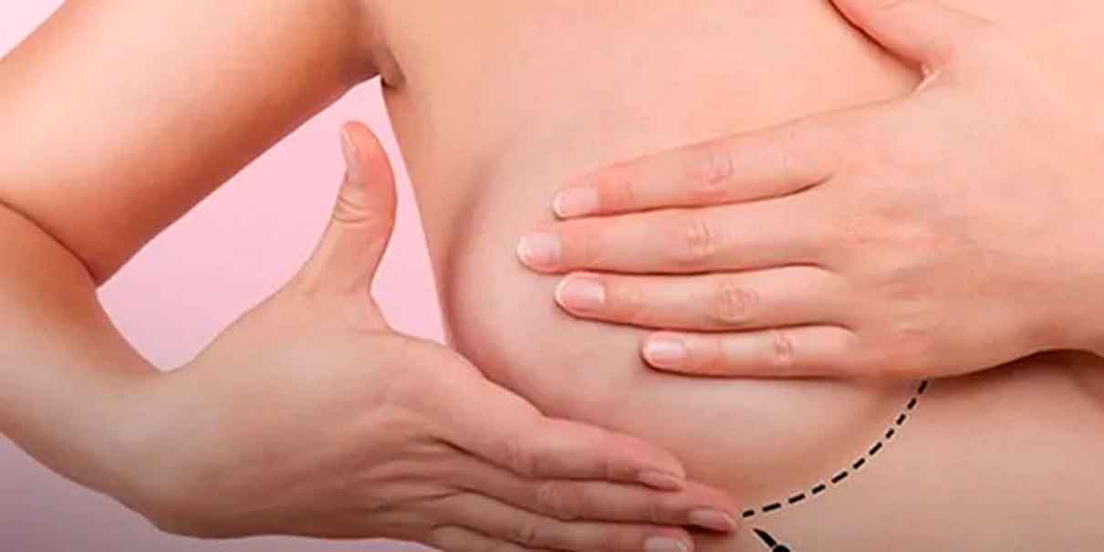 Cáncer de mama