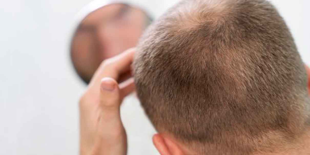 Alopecia en hombres