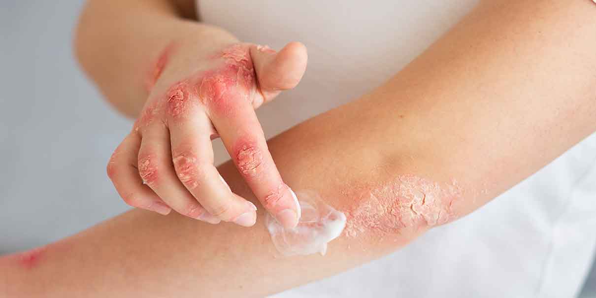 Dermatitis