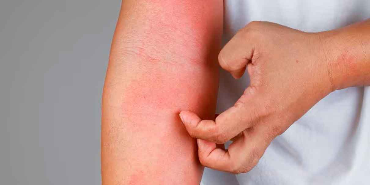 Dermatitis