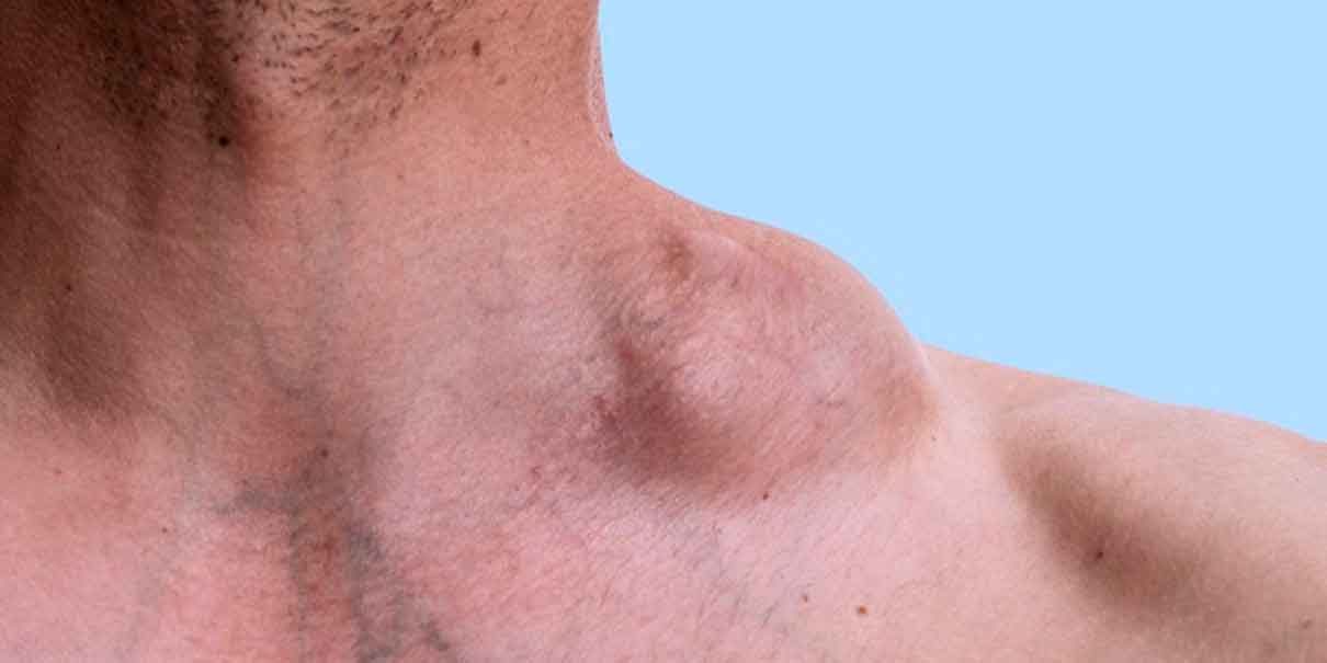 linfoma