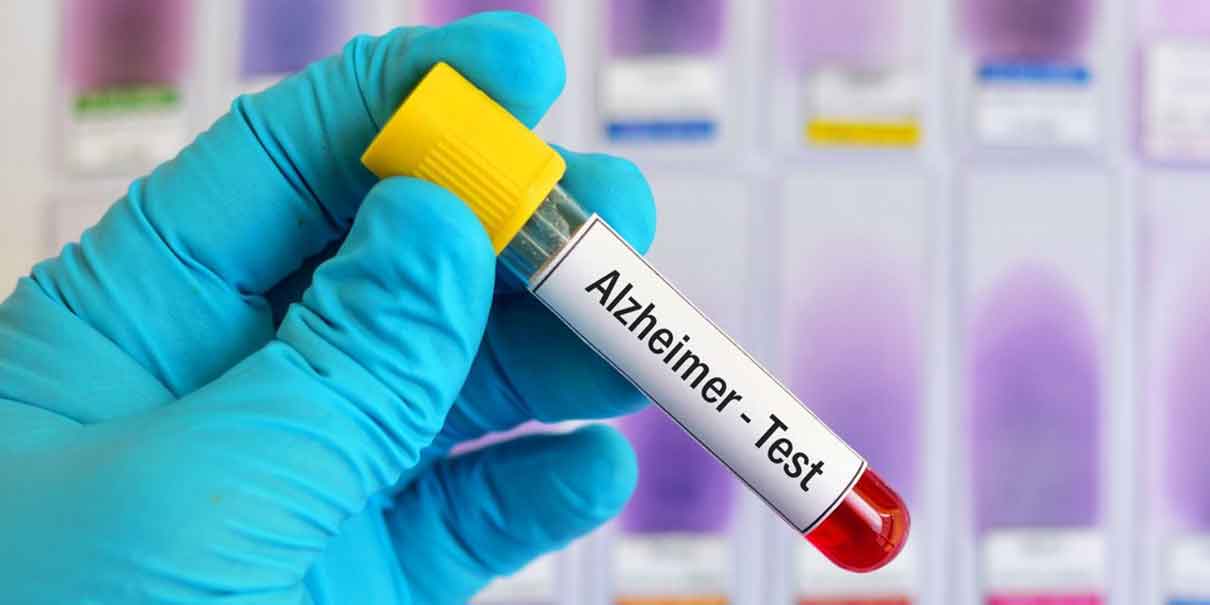 Alzheimer 