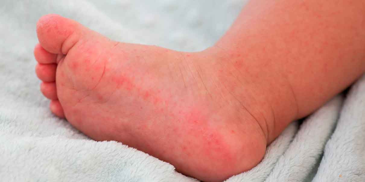 Virus Coxsackie