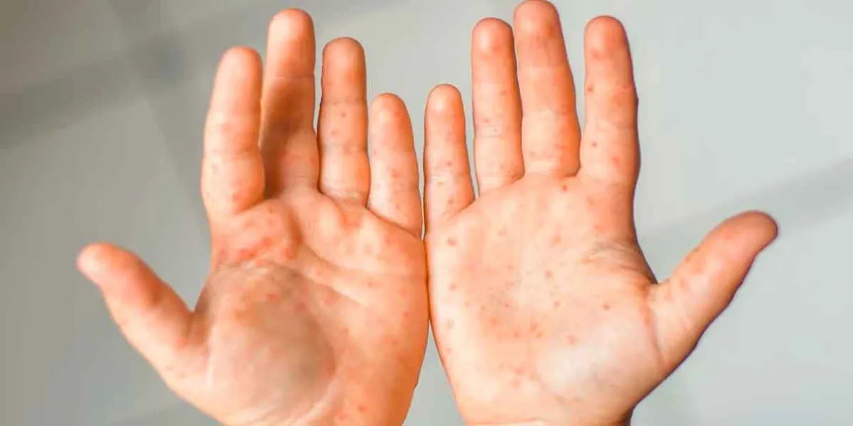 Virus Coxsackie: todo lo que debes saber sobre esta infección viral