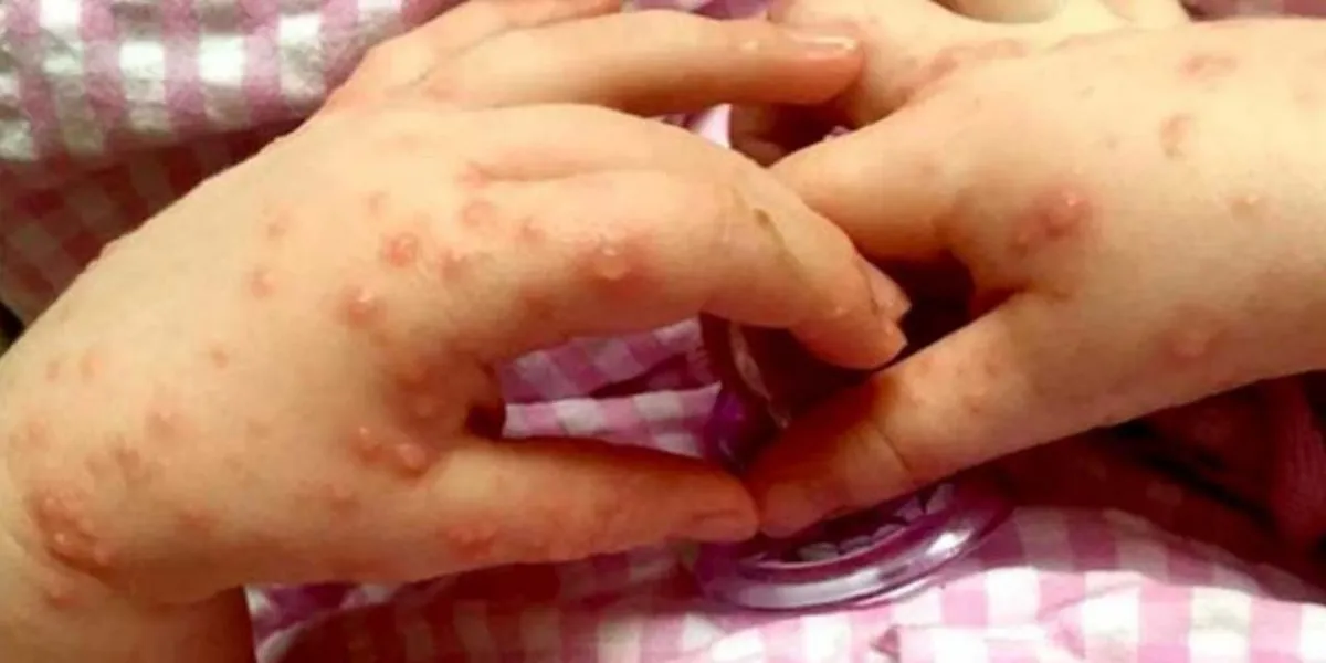 Brote de virus Coxsackie en Puebla: Suspenden clases en escuelas de Amalucan y la Mixteca