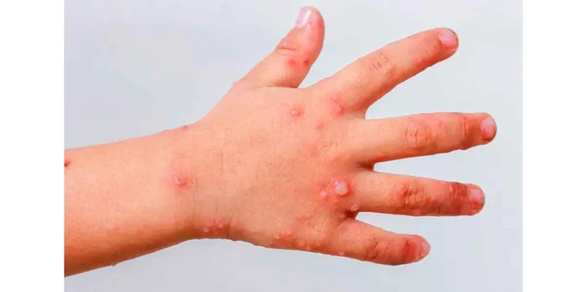 Autoridades de Chiautzingo refuerzan vigilancia por virus Coxsackie en niños