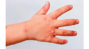 Autoridades de Chiautzingo refuerzan vigilancia por virus Coxsackie en niños