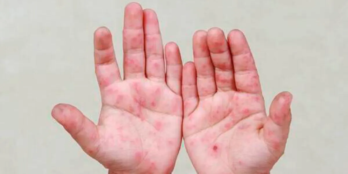 Detectan brote de virus Coxsackie en escuela de Ciudad Serdán