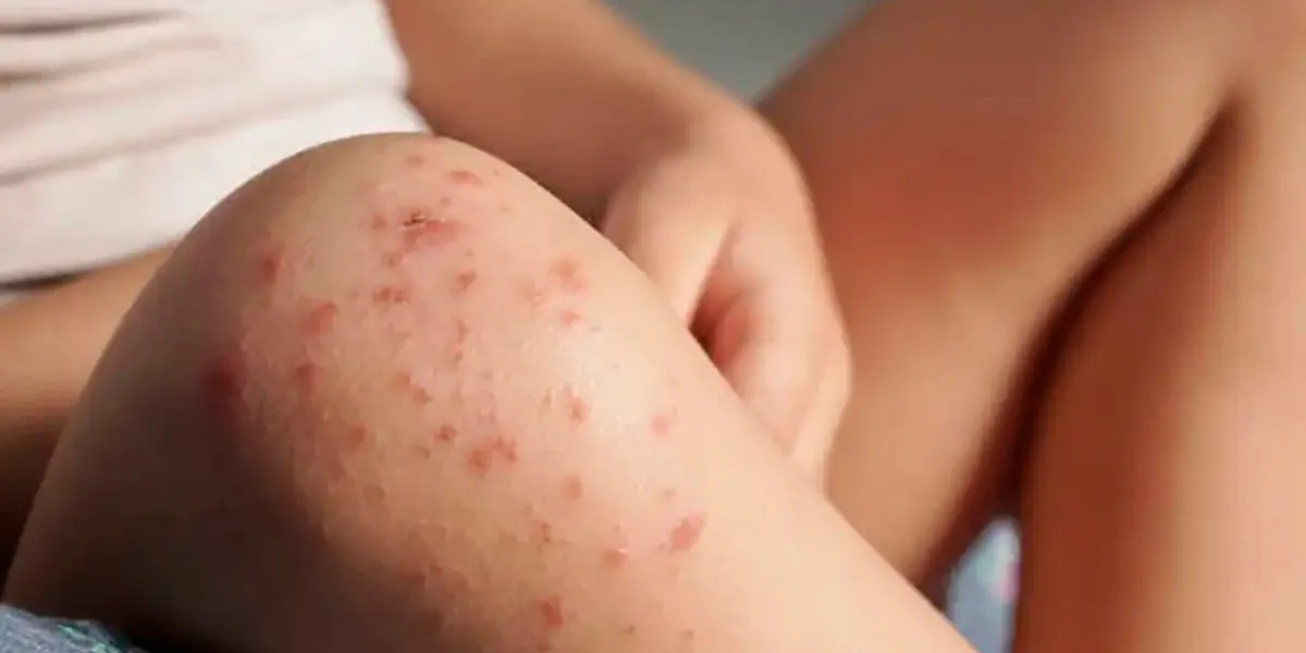 Brotes de virus Coxsackie aumentan en Puebla; suman 209 casos